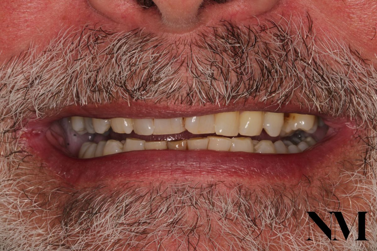 Smile Makeover Before