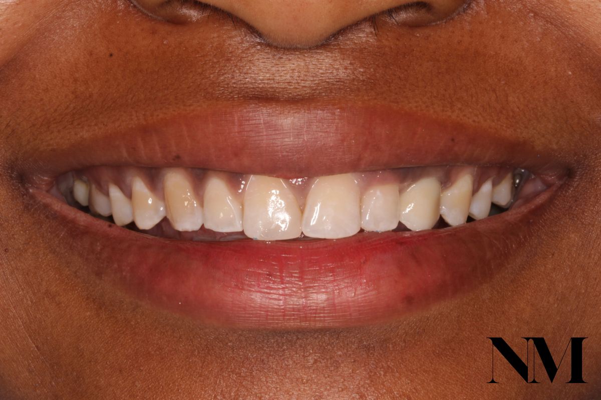 Front Tooth Implant After