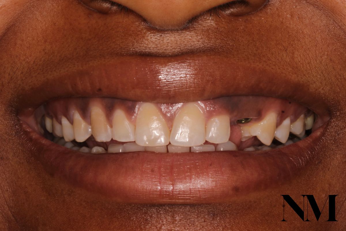 Front Tooth Implant Before