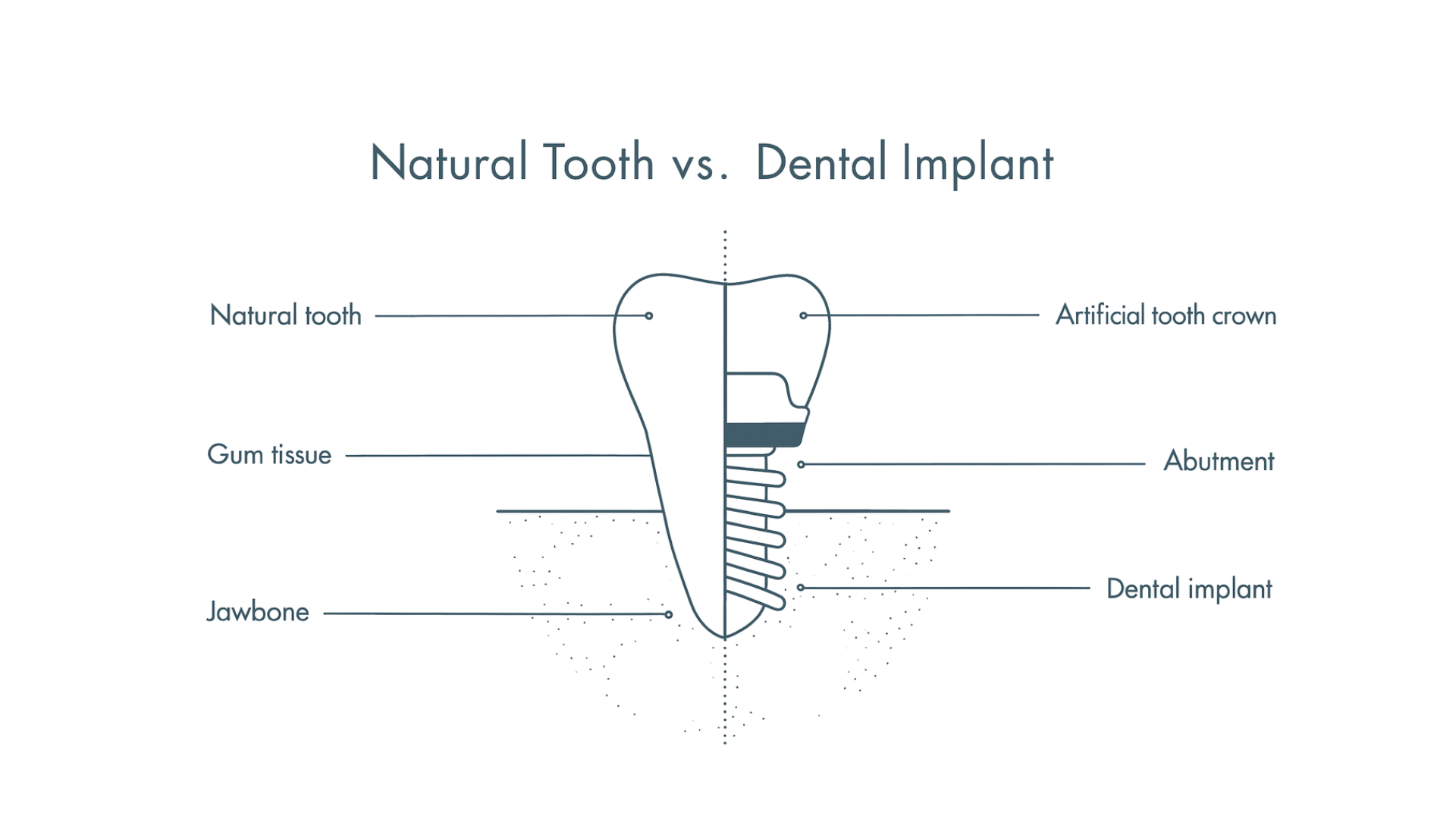 Dr Nicolas Montagnat Diagram Implant